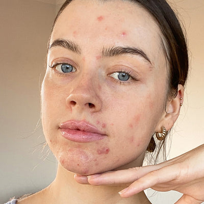 Maddie Edwards on Ditching Filters and Embracing Her Skin