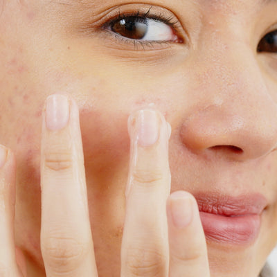 Do I Need To Moisturise If I Have Oily Or Combination Skin?