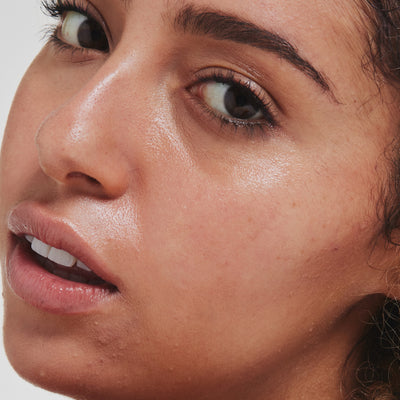 Everything You Need To Know About Using Retinal To Manage Acne