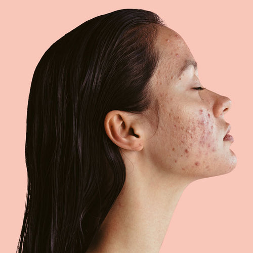 The Best Way To Treat Hyperpigmentation According To Dermatologists