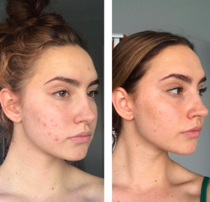 Laura's Routine For Acne Prone Skin